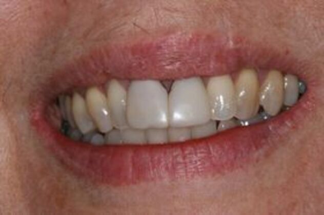 Dental Implants: Case 1 - Before