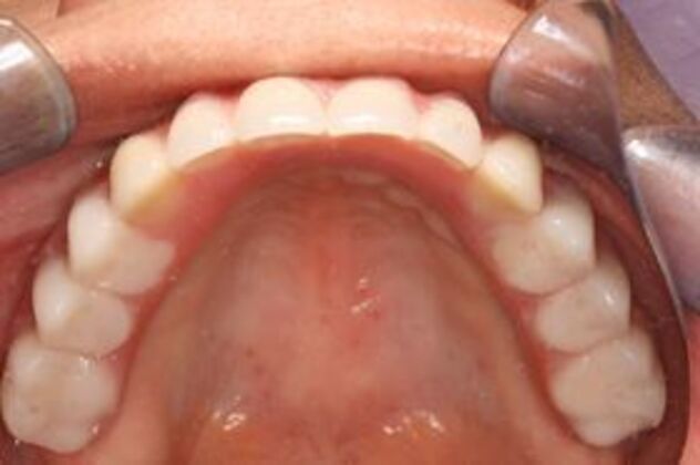 Dental Implants: Case 2 - After