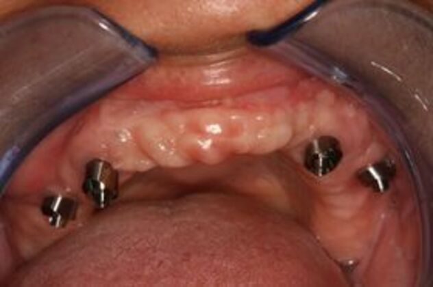 Dental Implants: Case 2 - Before
