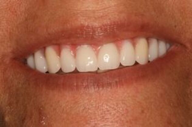 Dental Implants Case 2 - After