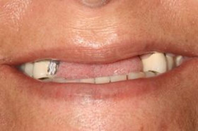 Dental Implants Case 2 - Before