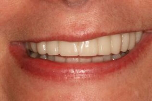 Smile Makeover: Case 1 - After