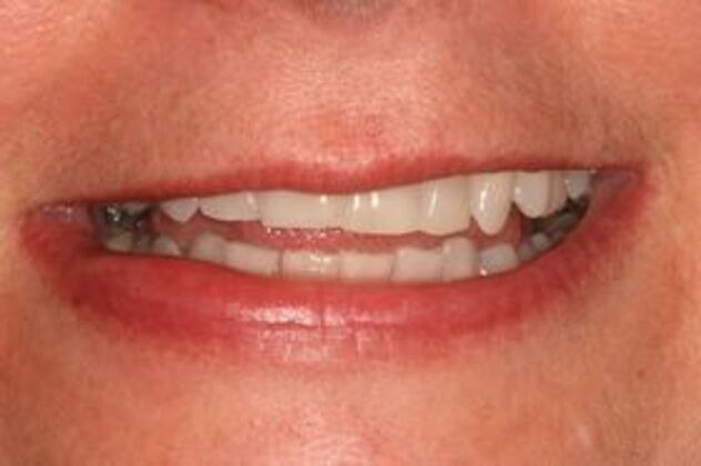 Smile Makeover: Case 1 - Before