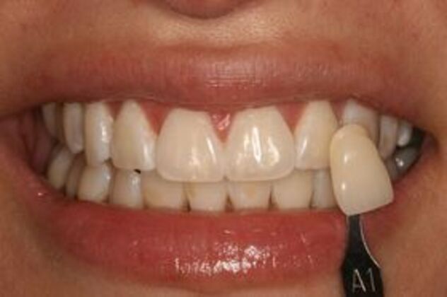 Teeth Whitening: Case 1 - shade tab comparison after whitening