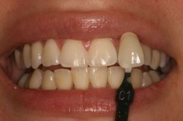 Teeth Whitening: Case 1 - shade tab comparison before whitening