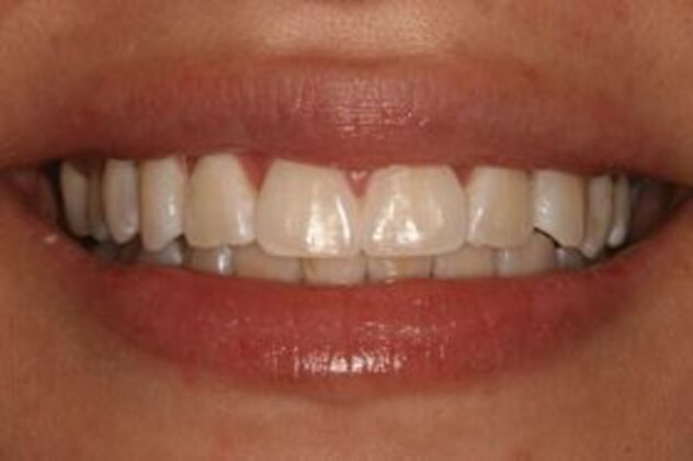 Teeth Whitening Case 1 - Before