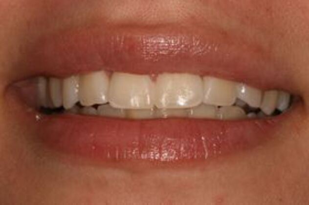 Teeth Whitening Case 1 - After