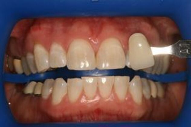Teeth Whitening: Case 2 - shade tab comparison after