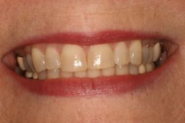 Teeth Whitening Case 2 - Before