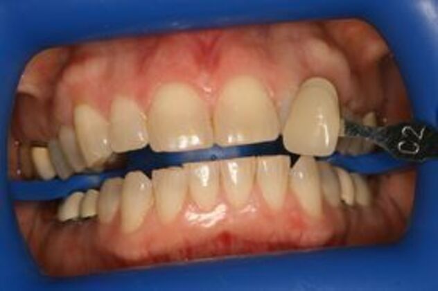 Teeth Whitening: Case 2 - shade tab comparison before