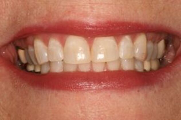 Teeth Whitening Case 2 - After