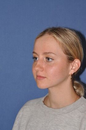 Rhinoplasty: Rhinoplasty for a bump - Before