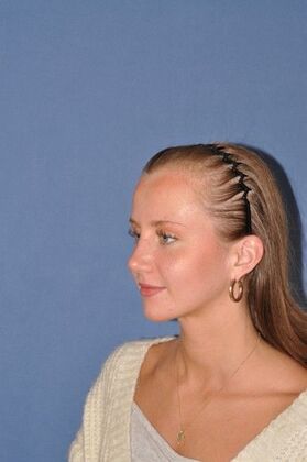 Rhinoplasty: Rhinoplasty for a bump - After
