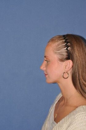 Rhinoplasty: Rhinoplasty for a bump - After