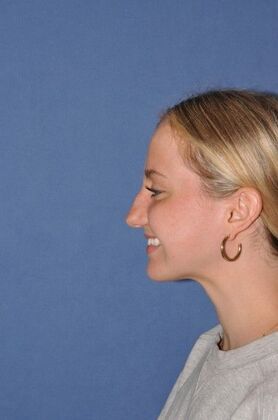 Rhinoplasty: Rhinoplasty for a bump - Before