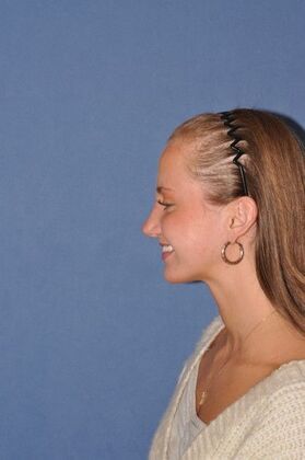 Rhinoplasty: Rhinoplasty for a bump - After