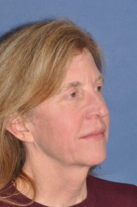 Facelift: Facelift and Necklift with a browlift - Before