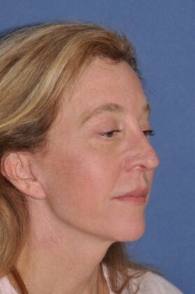 Facelift: Facelift and Necklift with a browlift - After