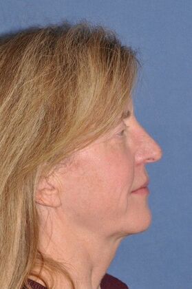 Facelift: Facelift and Necklift with a browlift - Before