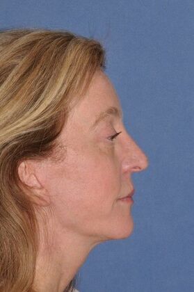 Facelift: Facelift and Necklift with a browlift - After