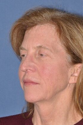 Facelift: Facelift and Necklift with a browlift - Before