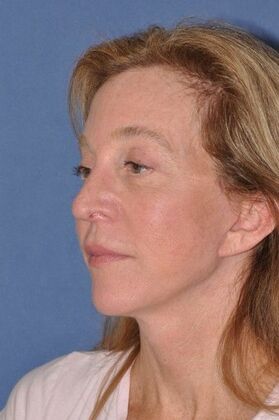 Facelift: Facelift and Necklift with a browlift - After