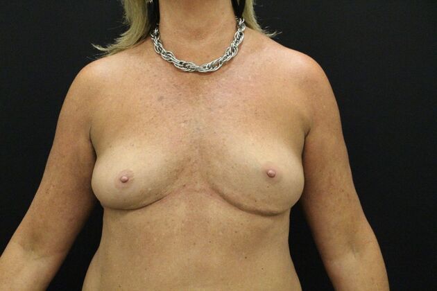 Breast Augmentation Case 47 - Before