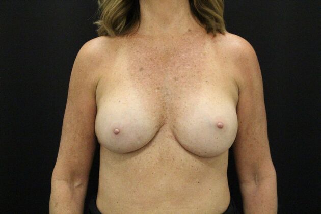 Breast Augmentation Case 47 - After