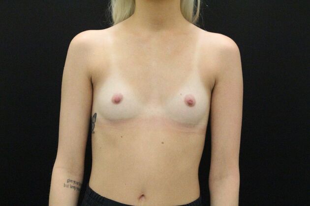 Breast Augmentation Case 48 - Before