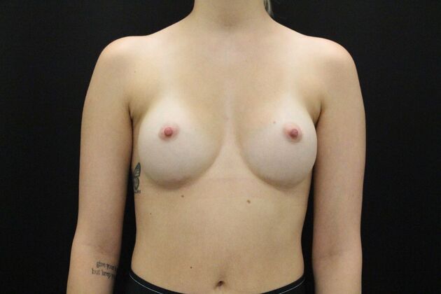 Breast Augmentation Case 48 - After