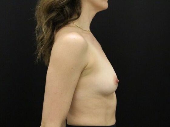 Breast Augmentation: Case 121 - Before