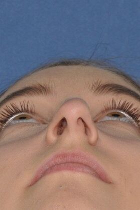 Rhinoplasty: Crooked nose with crooked septum and drooping tip - Before