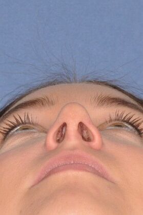 Rhinoplasty: Crooked nose with crooked septum and drooping tip - After