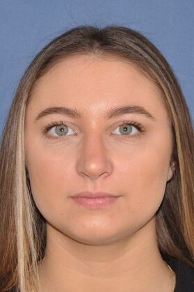 Rhinoplasty: Crooked nose with crooked septum and drooping tip - After