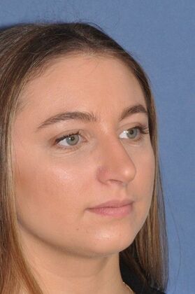 Rhinoplasty: Crooked nose with crooked septum and drooping tip - After