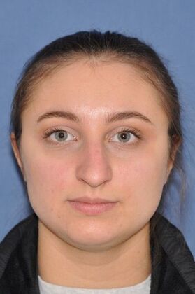 Rhinoplasty: Crooked nose with crooked septum and drooping tip - Before