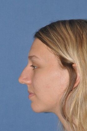 Rhinoplasty: 6 Years after, crooked and a bump - Before