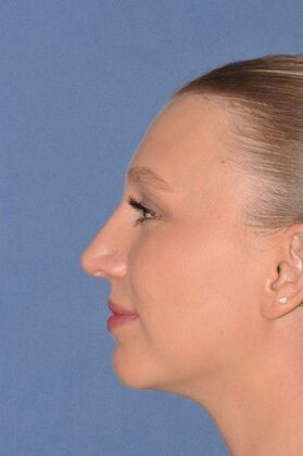 Rhinoplasty: 6 Years after, crooked and a bump - After