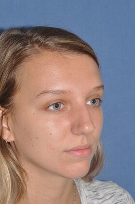 Rhinoplasty: 6 Years after, crooked and a bump - Before