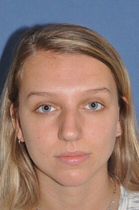 Rhinoplasty: 6 Years after, crooked and a bump - Before