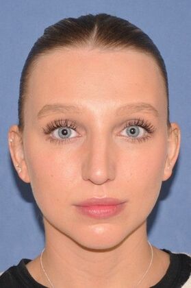 Rhinoplasty: 6 Years after, crooked and a bump - After