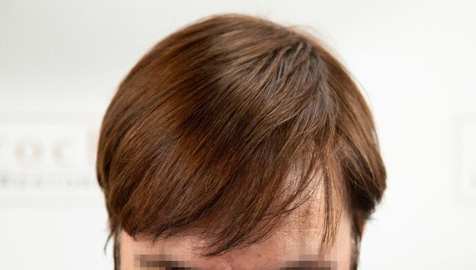 FUT Hair Restoration: Case 49 - After