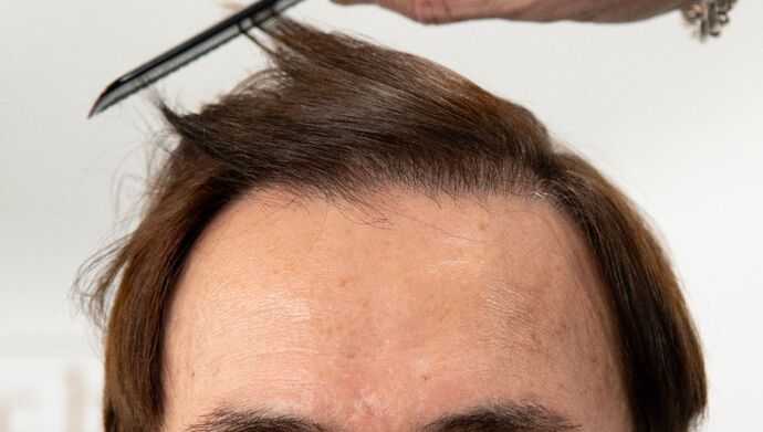 FUT Hair Restoration: Case 49 - After