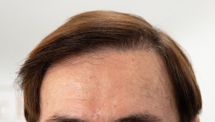 FUT Hair Restoration Case 49 - After