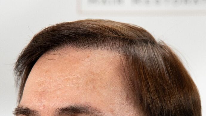 FUT Hair Restoration: Case 49 - After