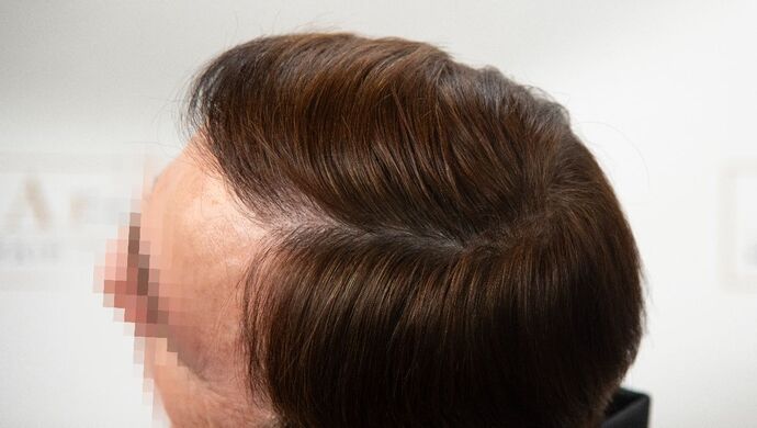 FUT Hair Restoration: Case 49 - After