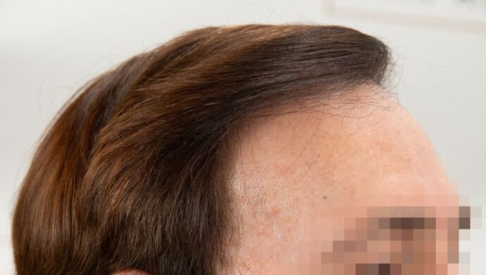 FUT Hair Restoration: Case 49 - After