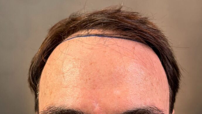 FUT Hair Restoration Case 49 - Before