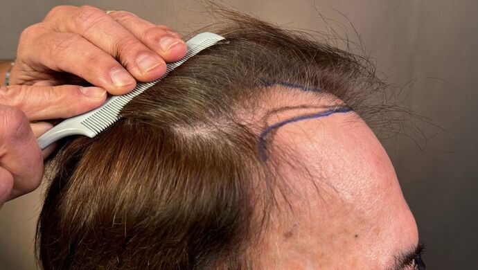 FUT Hair Restoration: Case 49 - Before