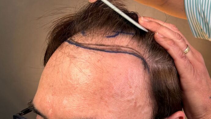 FUT Hair Restoration: Case 49 - Before